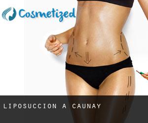 Liposuccion à Caunay