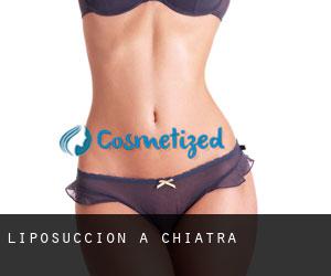 Liposuccion à Chiatra