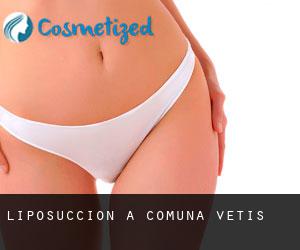 Liposuccion à Comuna Vetiş