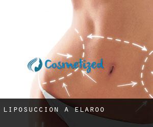 Liposuccion à Elaroo