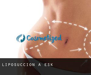 Liposuccion à Esk