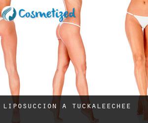 Liposuccion à Tuckaleechee