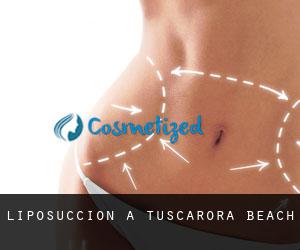 Liposuccion à Tuscarora Beach