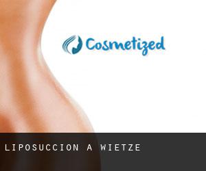 Liposuccion à Wietze